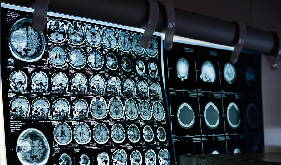 Concussions are a type of brain injury